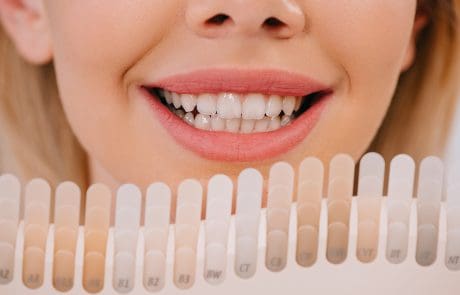 faccette dentali estetiche