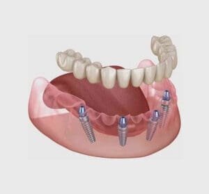 Implantologia a carico immediato - denti fissi in un giorno