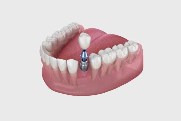 Implantologia a Carico Immediato Denti fissi in un solo giorno 2