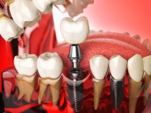 impianti dentali denti fissi in un solo giorno
