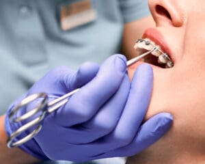 quanto costa un apparecchio per i denti prezzi e soluzioni