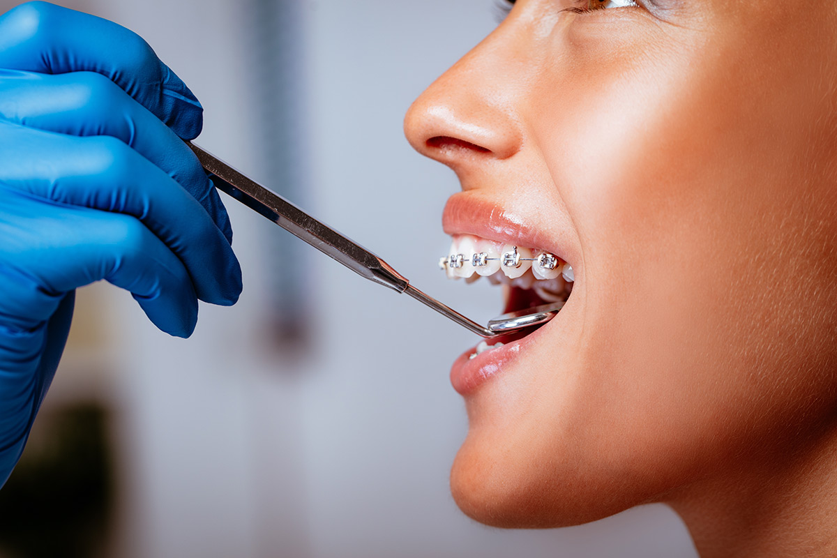 Quanto Costa un Apparecchio per i Denti? Prezzi e Soluzioni
