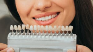 faccette dentali cosa sono e quanto costano