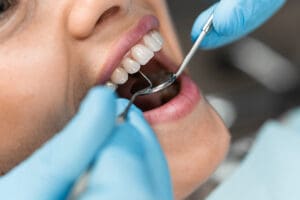 corone dentali cosa sono quando servono e quanto costano