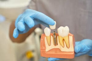 corone dentali cosa sono quando servono e quanto costano