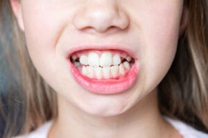 bruxismo sintomi cause e quando serve il bite