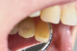 bruxismo sintomi cause e quando serve il bite