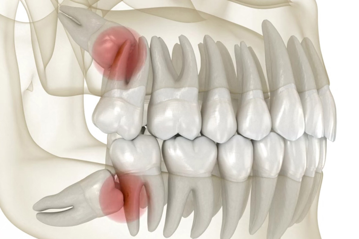 Dente del giudizio: quando va tolto e quando si può lasciare