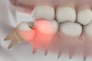 dente del giudizio quando va tolto e quando si puo lasciare