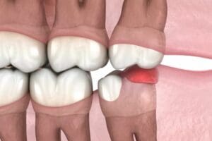 dente del giudizio quando va tolto e quando si puo lasciare