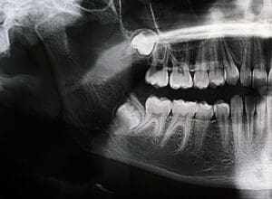 dente del giudizio quando va tolto e quando si puo lasciare